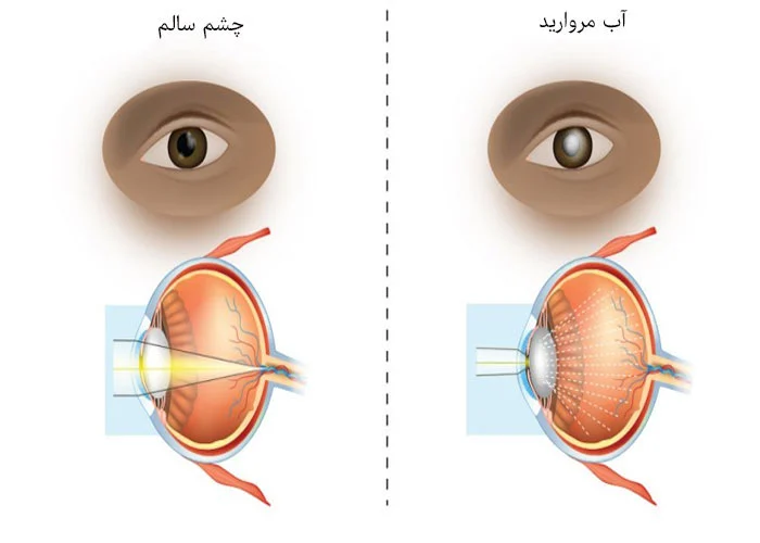 تفاوت چشم سالم با چشم آب مروارید