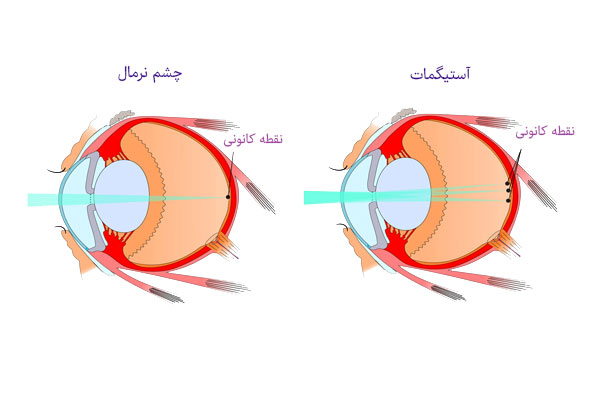 تفاوت-چشم-نرمال-با-آستیگمات