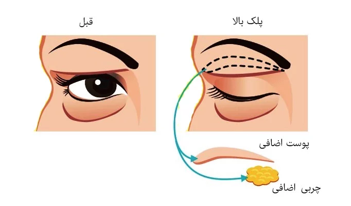 مزایای جراحی بلفاروپلاستی