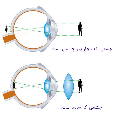چشم-سالم-و-چشم-دچار-پیرچشمی