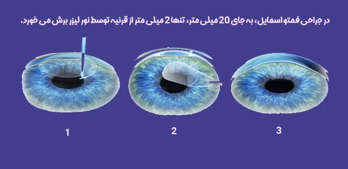 نحوه انجام جراحی فمتو اسمایل