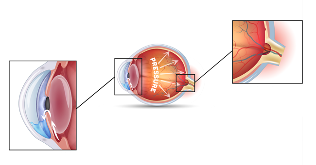 گلوکوما، عامل فشار چشم