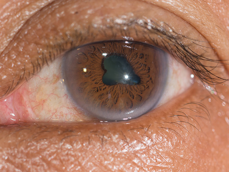 درباره عفونت داخل کره چشم