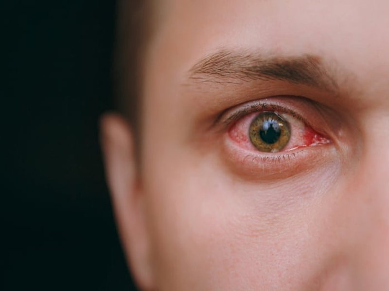 سوزش چشم پس از عمل لیزیک چشم